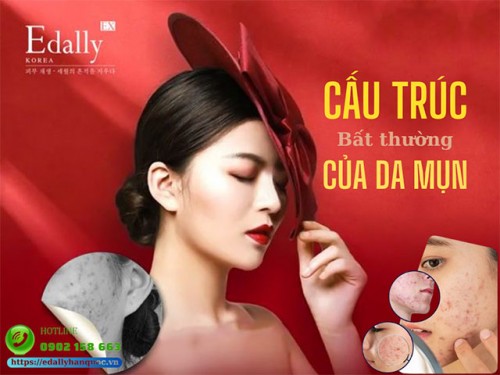 Cấu Trúc Bất Thường Của Da Mụn Và Cách Xử Lý