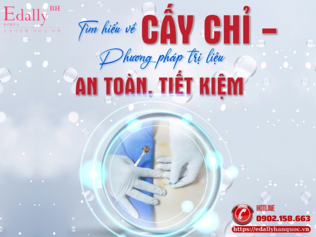 Cấy chỉ điều trị: Hiểu đúng để ứng dụng an toàn và hiệu quả