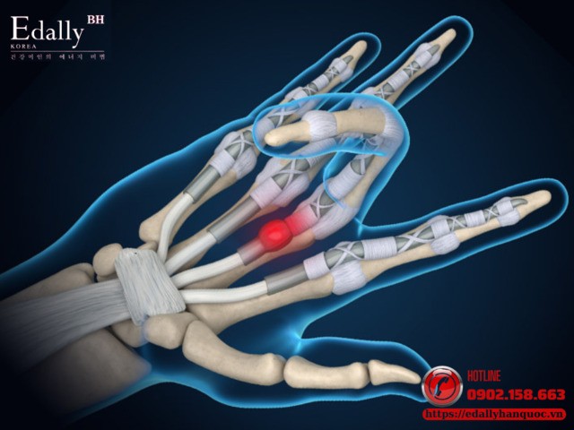 Châm cứu điều trị hiệu quả hội chứng ngón tay lò xo có hiệu quả không?