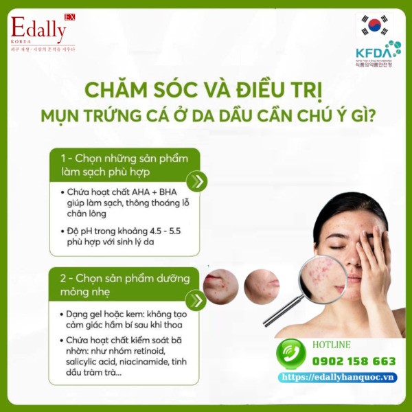 Chăm sóc và điều trị mụn trứng cá ở làn da dầu cần chú ý điều gì?