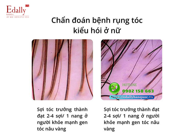 Chẩn đoán bệnh rụng tóc kiểu hói ở nữ giới