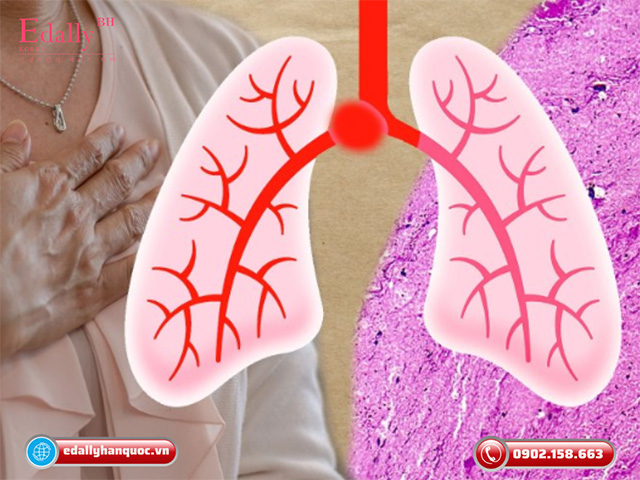 Chẩn đoán và xử lý nhồi máu phổi thế nào?