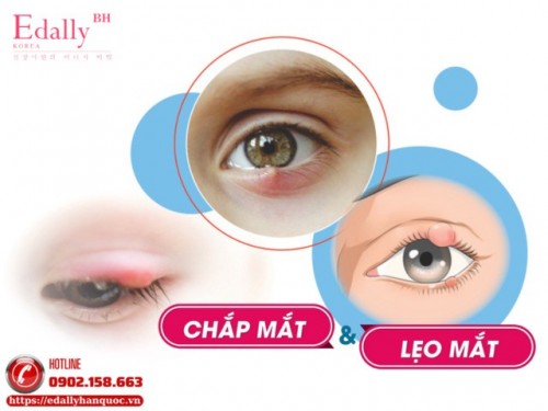 Chắp Lẹo Và Cách Điều Trị Kết Hợp Đông - Tây Y