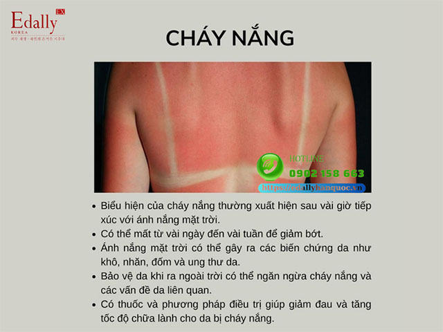 Cháy nắng do ánh nắng mặt trời là bệnh lý ngoài da thường gặp vào mùa hè