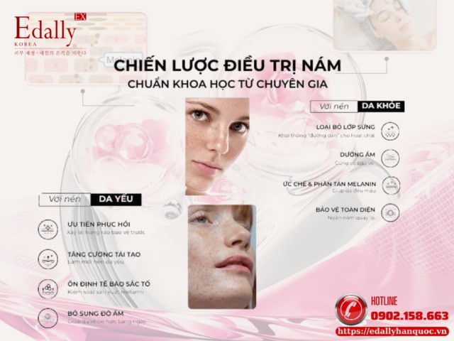 Chiến lược điều trị nám da chuẩn khoa học từ chuyên gia da liễu