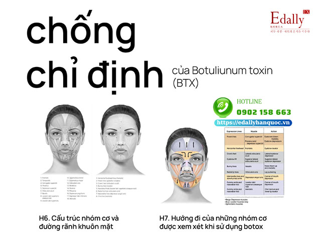 Chống chỉ định của tiêm Botox (Botulinum Toxin)?