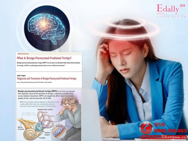 Cập nhật chóng mặt tư thế kịch phát lành tính (BPPV) mới nhất từ Jama 2026