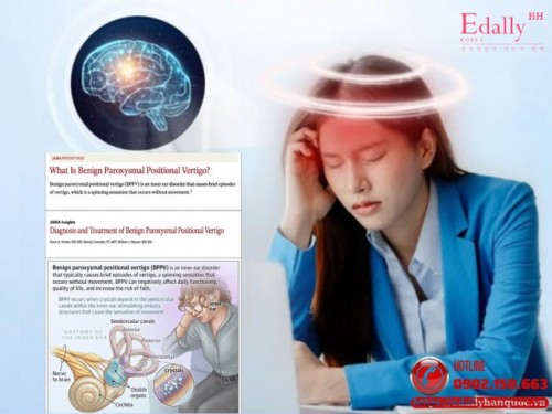 Chóng Mặt Tư Thế Kịch Phát Lành Tính (BPPV) - Cập Nhật Mới Nhất Từ Jama 2026
