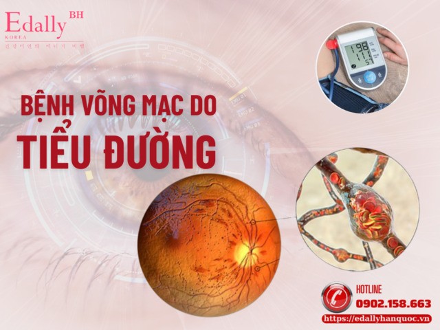 Biến chứng võng mạc gây suy giảm thị lực ở bệnh nhân tiểu đường