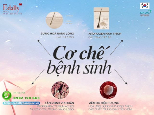 Cơ chế bệnh sinh mụn ở phụ nữ trưởng thành