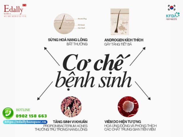 Cơ chế bệnh sinh mụn nội tiết