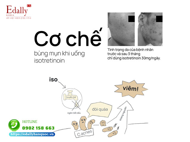 Cơ chế bùng phát mụn sau khi uống isotretinoin