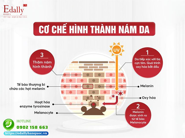 Cơ chế tích tụ sắc tố melanin và hình thành nám da