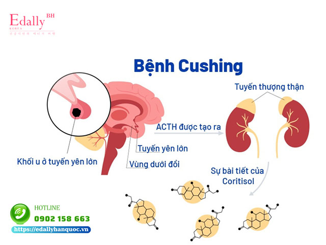 Cơ chế gây bệnh hội chứng Cushing