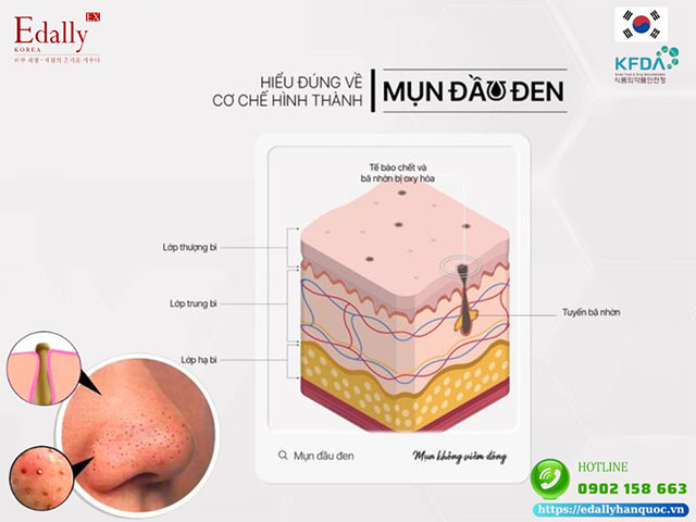 Hiểu đúng về cơ chế hình thành mụn đầu đen để điều trị dứt điểm