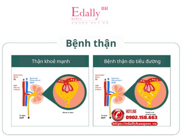 Cơ chế gây tổn thương thận trong bệnh tiểu đường