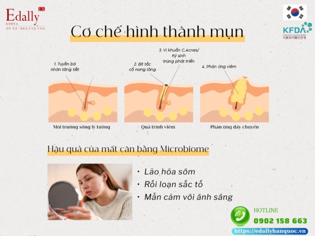 Cơ chế hình thành mụn do thảm vi sinh trên da (Microbiome)