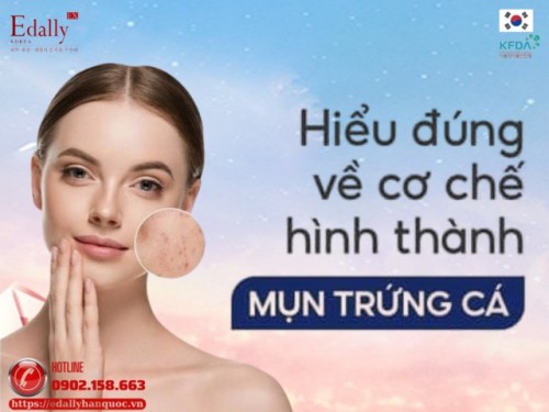 Cơ chế hình thành mụn trứng cá và cách điều trị hiệu quả