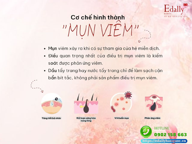 Mụn viêm được hình thành như thế nào?