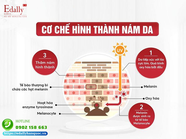 Cơ chế hình thành nám trên da