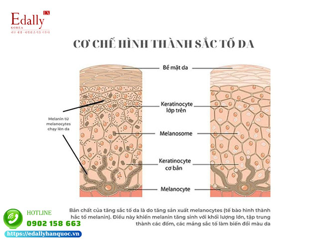 Cơ chế hình thành của tăng sắc tố da