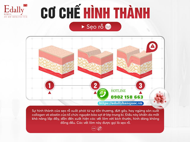 Quá trình hình thành sẹo rỗ