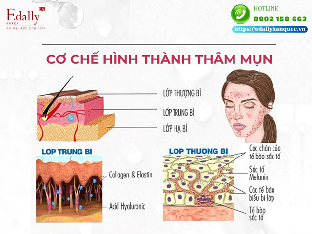 Cơ chế hình thành thâm mụn