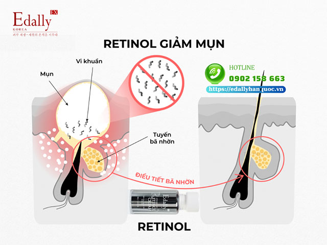 Retinol điều trị mụn như thế nào?