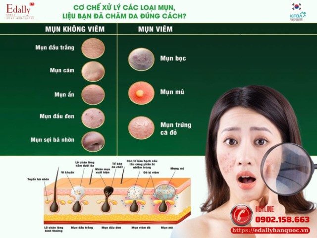 Cơ chế xử lý các loại mụn, liệu bạn đã chăm da đúng cách?