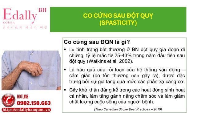 Co cứng sau đột quỵ não là gì?