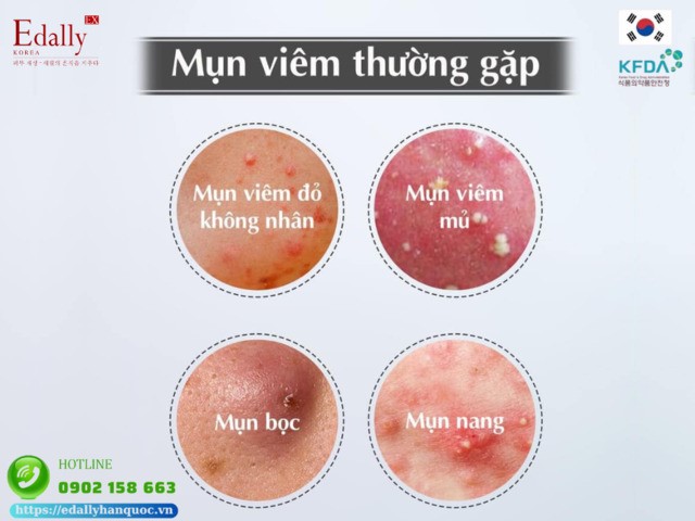 Có những loại mụn viêm nào?