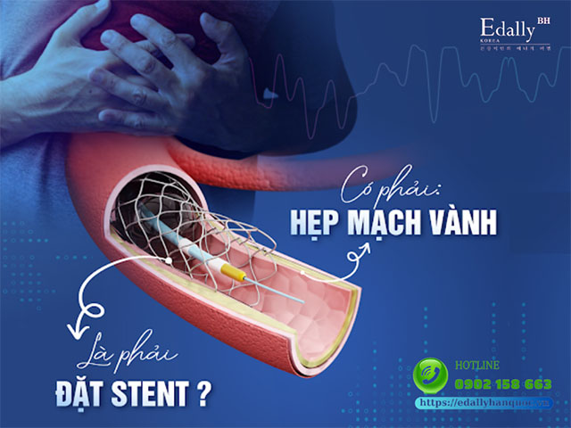 Có phải cứ bị hẹp mạch vành là phải đặt stent tim mạch vành?