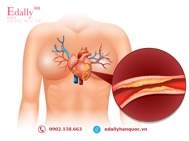 Có nhiều mức độ biểu hiện của triệu chứng của bệnh co thắt động mạch vành