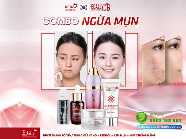 Combo skincare cho làn da mụn ẩn và mụn đầu đen