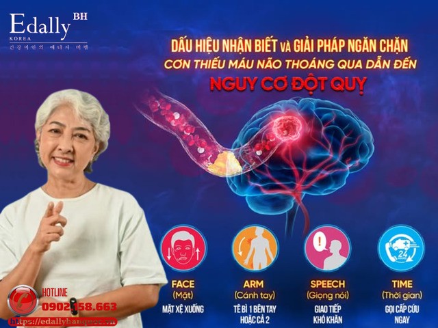 Cơn thiếu máu não thoáng qua (TIA): Chỉ là dấu hiệu nhẹ như gió thoảng nhưng có thể là cảnh báo nguy cơ đột quỵ não