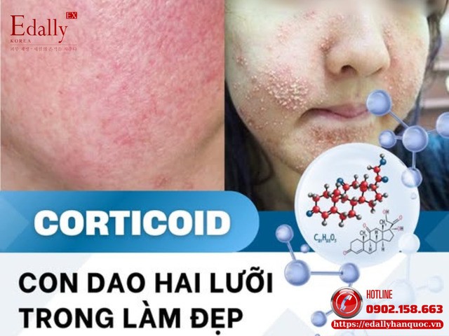 Corticoid - con dao hai lưỡi trong làm đẹp