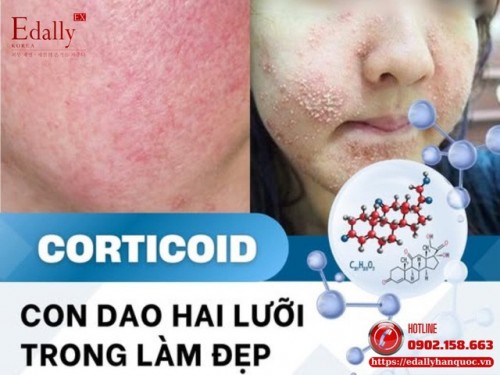 Corticoid - Con Dao Hai Lưỡi Trong Làm Đẹp