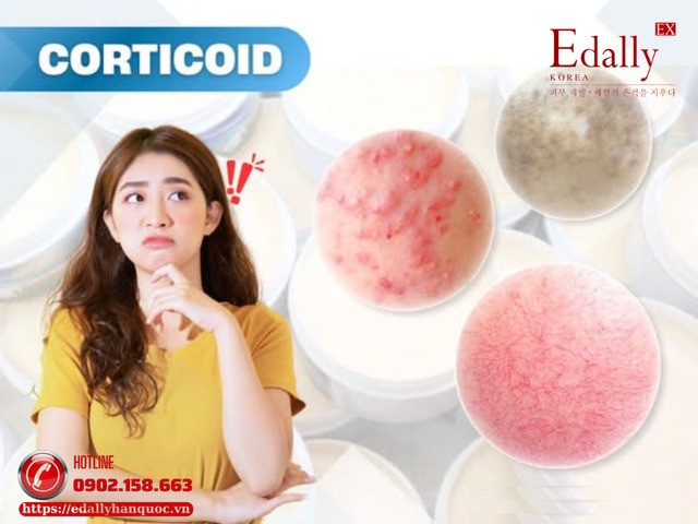 Corticoid - Khi làn da đẹp thần tốc lại là một cái bẫy