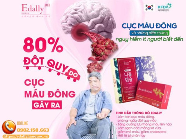 Cục máu đông là nguyên nhân hàng đầu gây đột quỵ