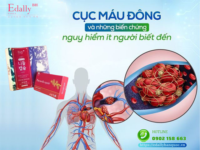 Cục máu đông gây những biến chứng nguy hiểm mà ít người biết đến