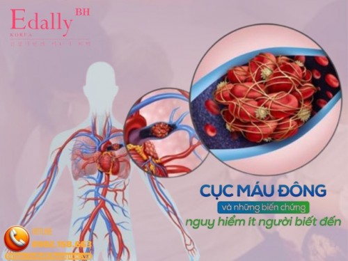 Cơ Thể Đang Giữ Cục Máu Đông Ở Vị Trí Mà Bạn Không Ngờ Tới