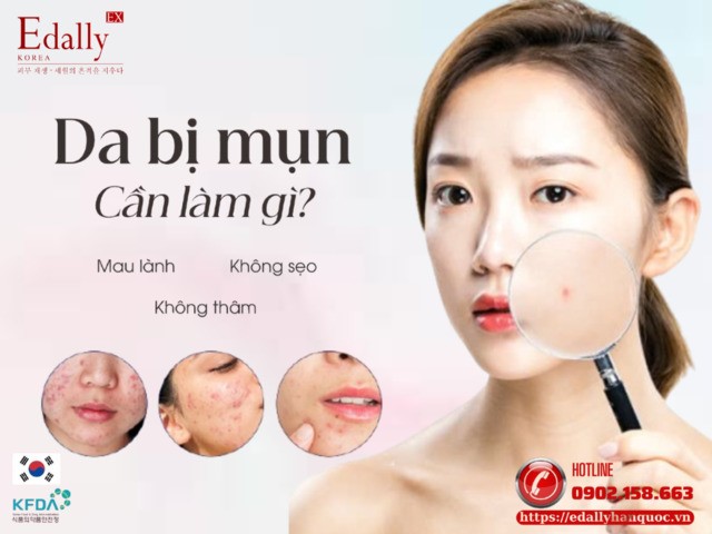 Cần làm gì khi da bị mụn để mau lành, không sẹo, không thâm?