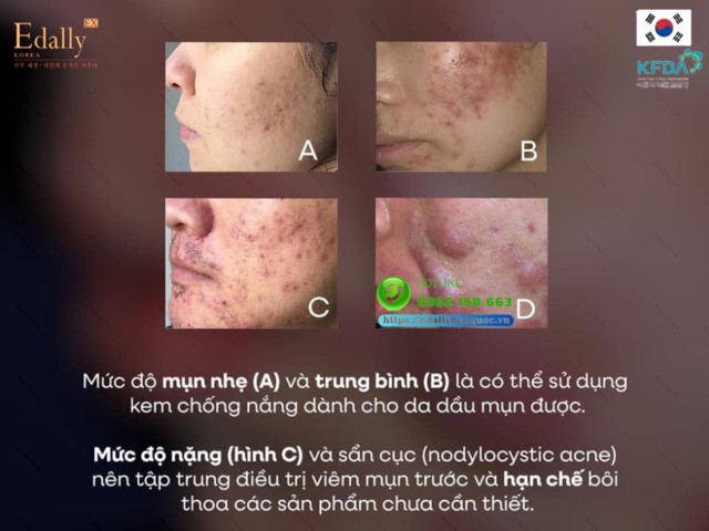 Da mụn có nên sử dụng kem chống nắng hay không tùy thuộc vào tình trạng mụn trên da