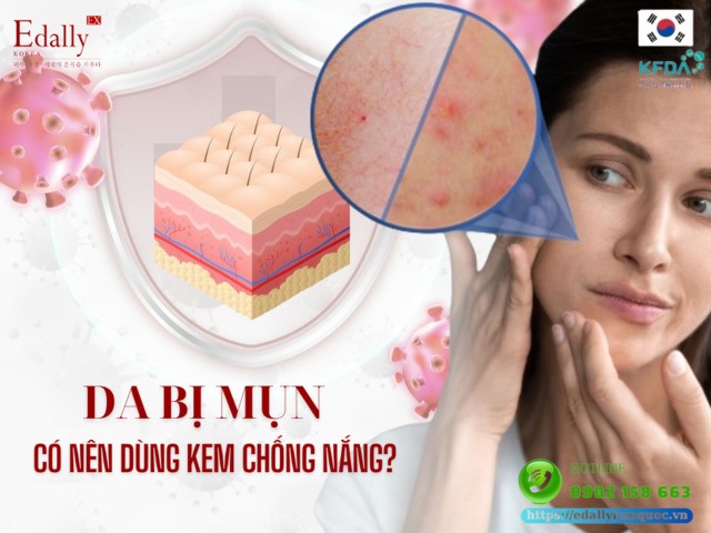 Da bị mụn có nên dùng kem chống nắng không?