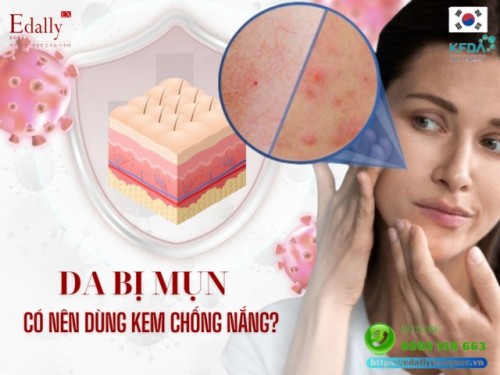 Da Mụn Có Nên Thoa Kem Chống Nắng Không?