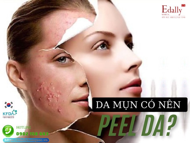 Da bị mụn có nên peel da không?