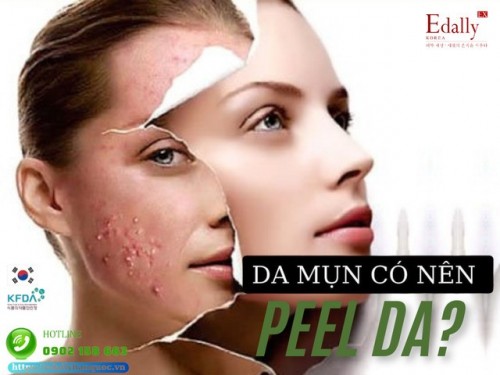 Da Bị Mụn Có Nên Peel Da Không?