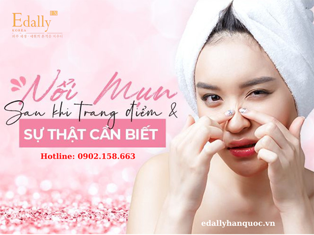 Makeup xong da bị mụn thì phải làm sao?