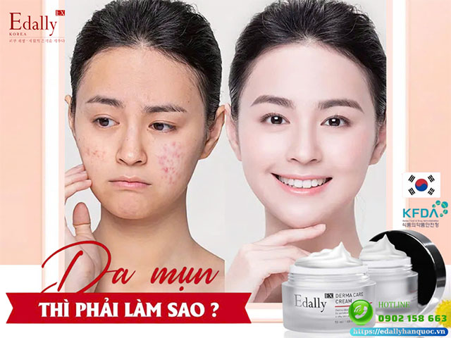 Da bị mụn thì phải làm sao để trị mụn dứt điểm?