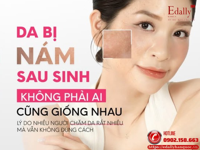 Nám Sau Sinh Và Phác Đồ Xử Lý Hiệu Quả